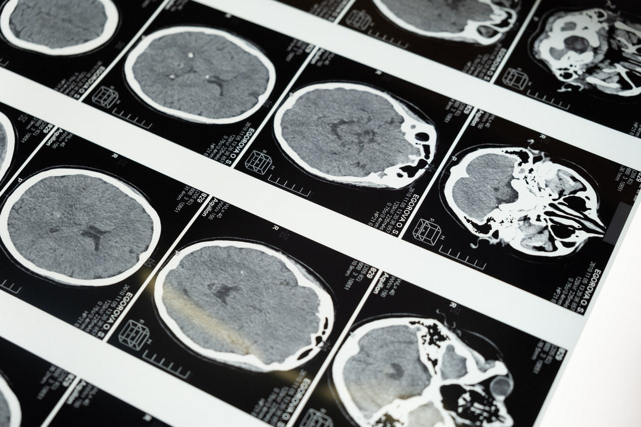 image of brain scans